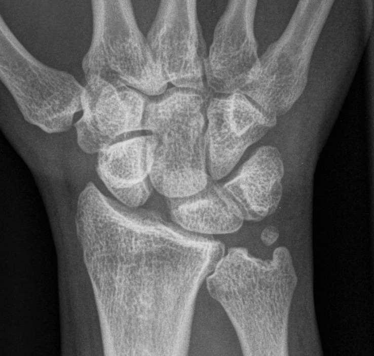 SL injury shortened scaphoid